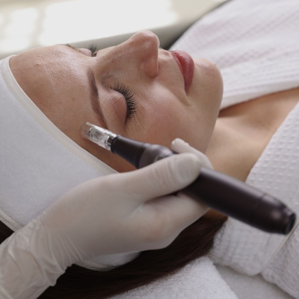 Microneedling Divina Beauty Heidenheim an der Brenz