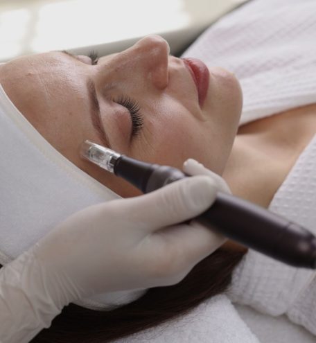 Microneedling Divina Beauty Heidenheim an der Brenz